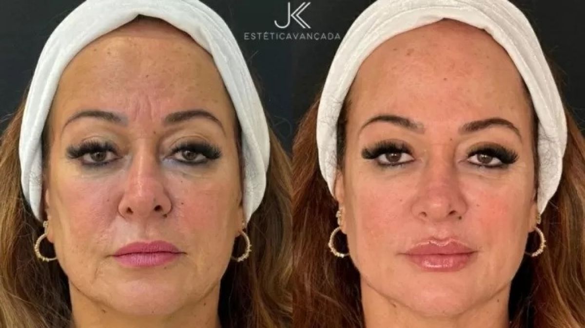 Mãe de Neymar passa por rejuvenescimento facial; veja
